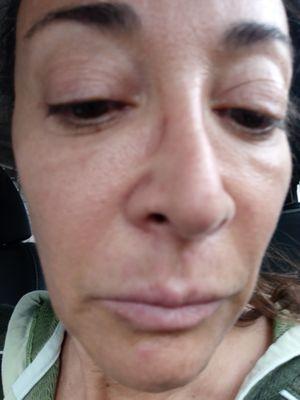 swelling under eyes lines around nose