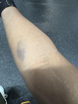 Next day my arm was bruised