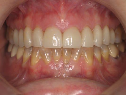 Natural looking porcelain restorations. Dentistry by Dr. Angulo.