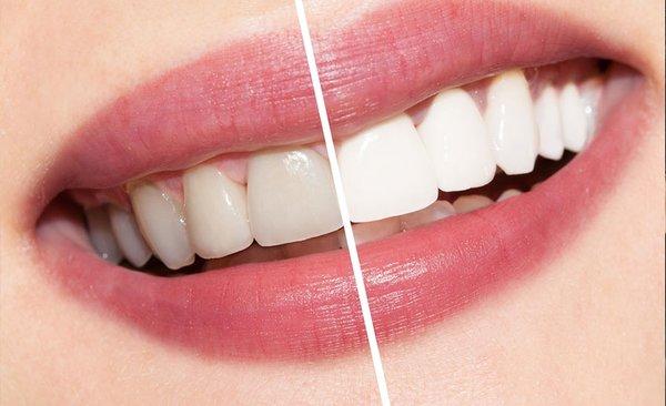 Tooth Whitening