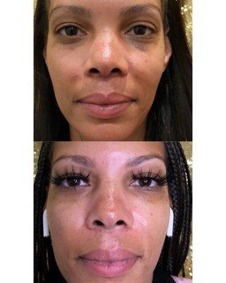 Radio Frequency used to build collagen and can be used all areas of the body. In this case we used it to tighten the under eye area.