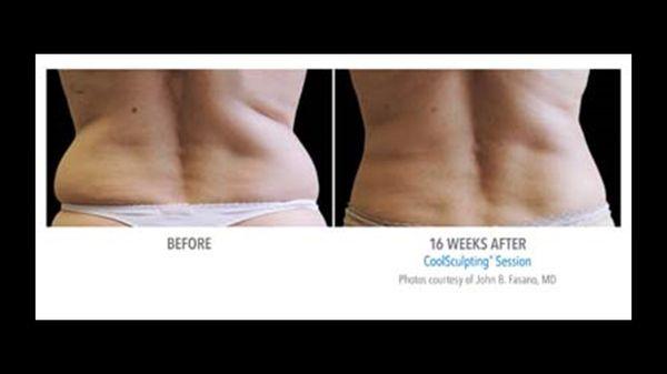 CoolSculpting