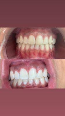 60 minute teeth whitening