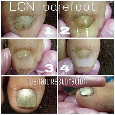 Vickie now offers LCN Barefoot, which reconstructs the toenail into the perfect nail you can be proud to show.