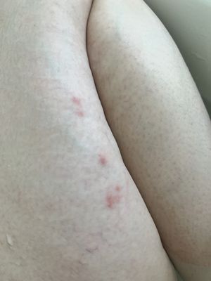 bed bug bites infected