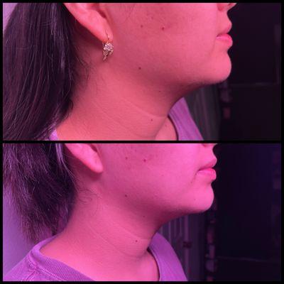 Double chin reduction