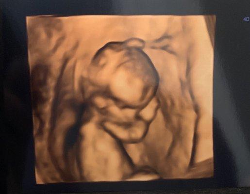 4D super gender check ultrasound @ 14 weeks