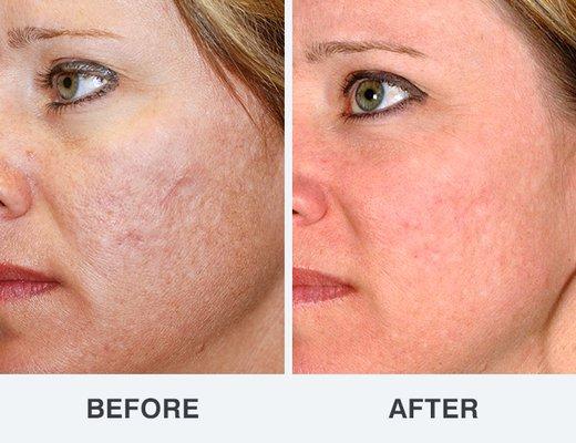 Micro needling with chemical peel