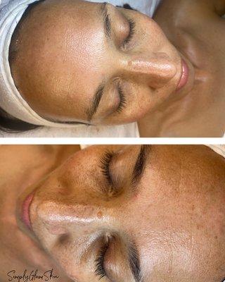 *DMK peel 
 *Vitamin A, C and E Oxygen treatment