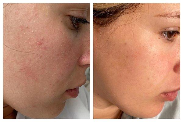 Before and after deep pore cleansing and milias removal