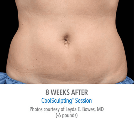 After CoolSculpting