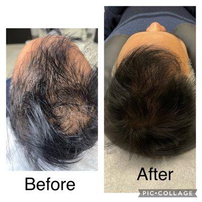 Scalp micropigmentation