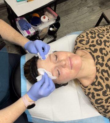 Microneedling with PRF. More potent than PRP. $600 per session or $1500 for 3 sessions. Included is PRF filler under eyes to thicken tissue