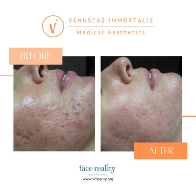 Acne Boot Camp Before & After - Med Spa in Janesville, WI