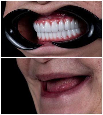 Full mouth rehabilitation with implants and Zirconia bridge.