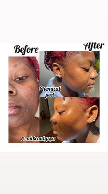 Before and after 1er Jessner's Chemical peel