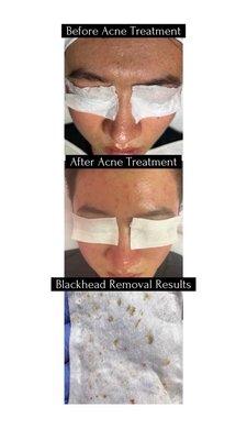 Acne treatment