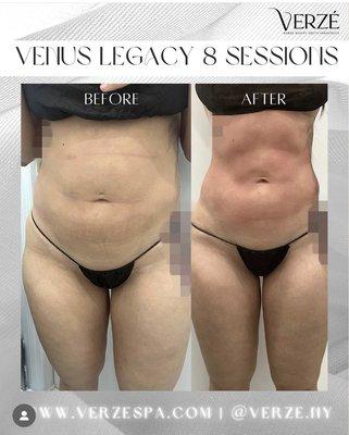 One package of Venus Legacy on the stomach area.