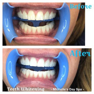 Teeth Whitening, before & after photo's