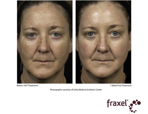 The Laser Center was the first clinic in the North Bay to offer the Fraxel Dual laser for pigmentation.