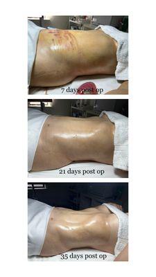 Liposuction Healing Progression