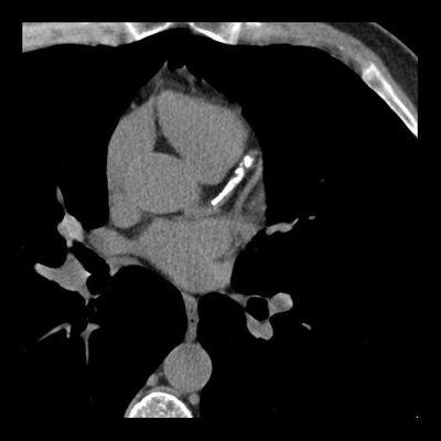 Find the plaque in your arteries your stress test missed with advanced Cardiac CT Imaging.