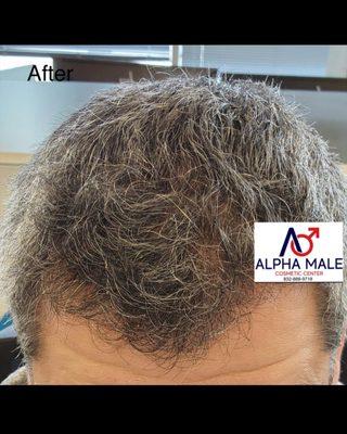 7 months after hair transplant