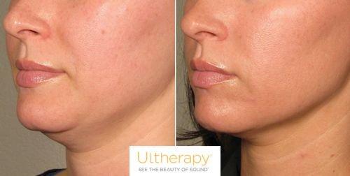 Before & After Ultherapy