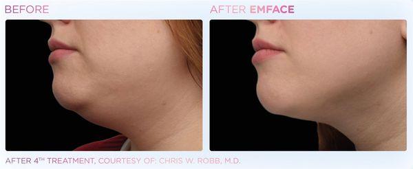 Emface is a non invasive nonsurgical procedure to help lift your face muscles, this procedure helps with jowls, skin laxity and facial aging