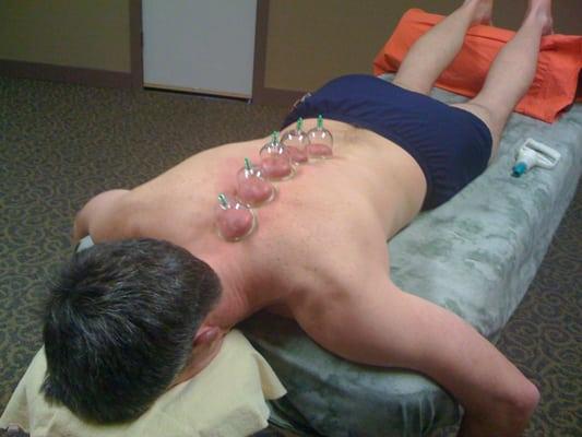 Cupping for kyphotic thoracic spine