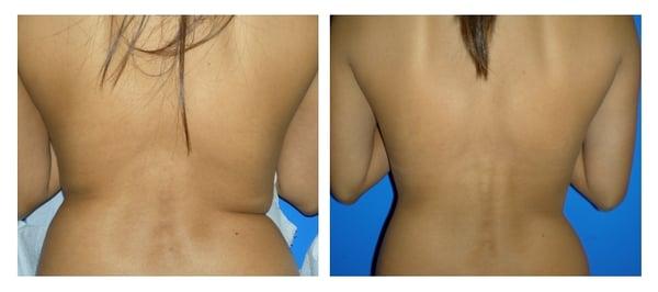 Before and after mesotherapy on back fat.