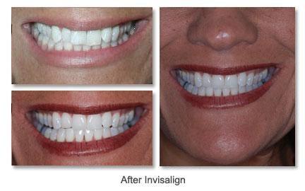 Before and After Invisalign Photo