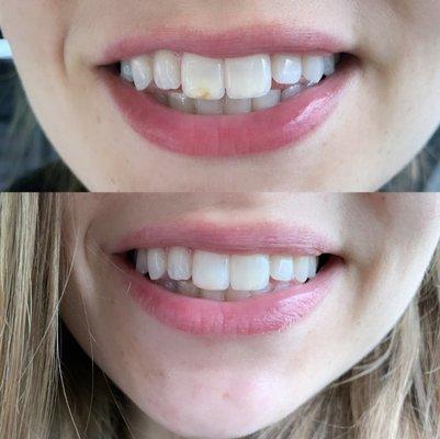 Top Photo- Tooth that grew in with discoloration & has been that way for 20 years Bottom Photo: Discolored tooth after being fixed here :-)