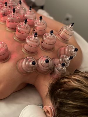 Cupping for upper back and shoulders pain and detox