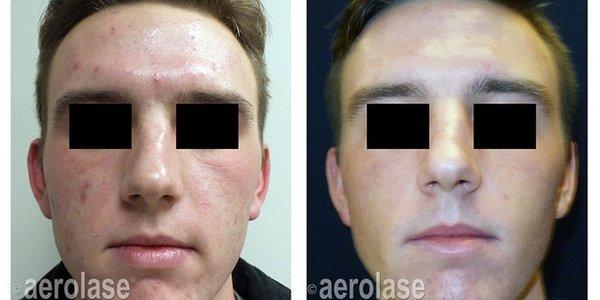 Neoclear acne treatment with Aerolase Neo Elite!