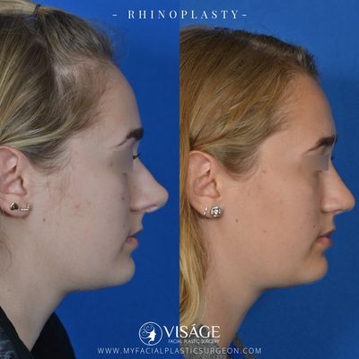 Before/after rhinoplasty to shorten the nose