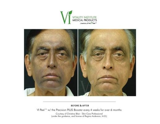 VI Peel on Malasma/Hyperpigmentation