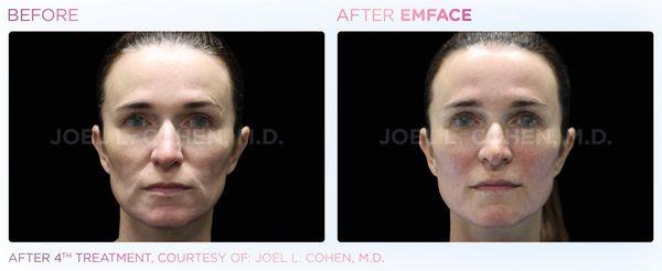 Emface is a non invasive nonsurgical procedure to help lift your face muscles, this procedure helps with jowls, skin laxity and facial aging