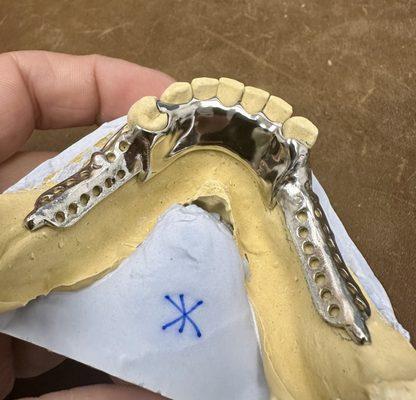 Metal Framework Replacing Missing Teeth