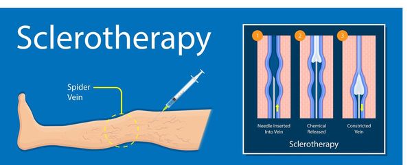 Sclerotherapy for spider veins