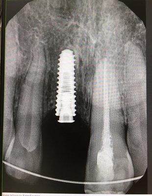 Hiossen brand Dental implant placed...