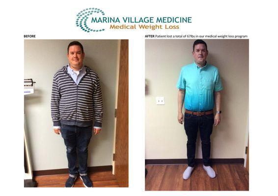 Medical Weight Loss Before and After in Alameda, CA