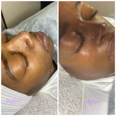 Dermaplane facial