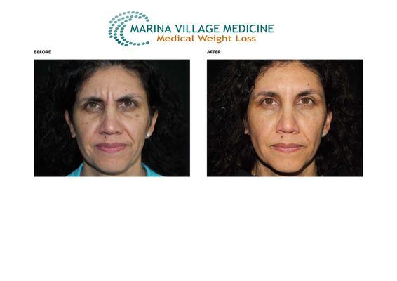 Botox Before and After for Frown Lines in Alameda, CA