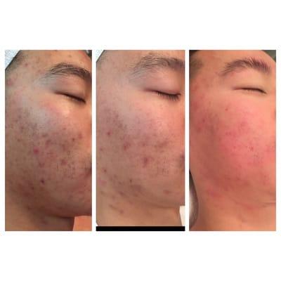 Acne Treatment Peels