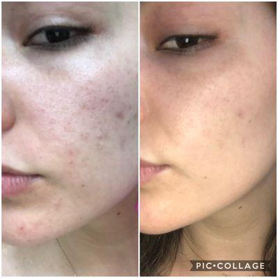 Before & After Microneedling