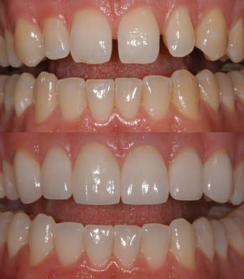 Porcelain Veneers Before/After Sample