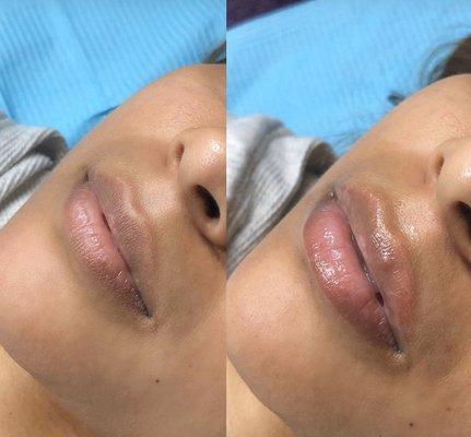 Needless lip enhancement