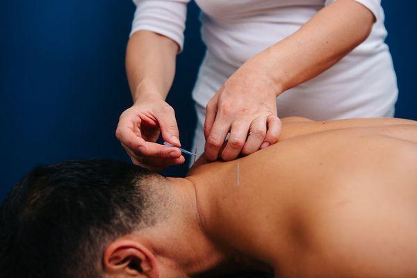 Acupuncture to treat neck and shoulder pain