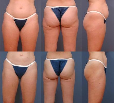 Learn more about liposuction http://www.drruas.com/proc_lipo.html